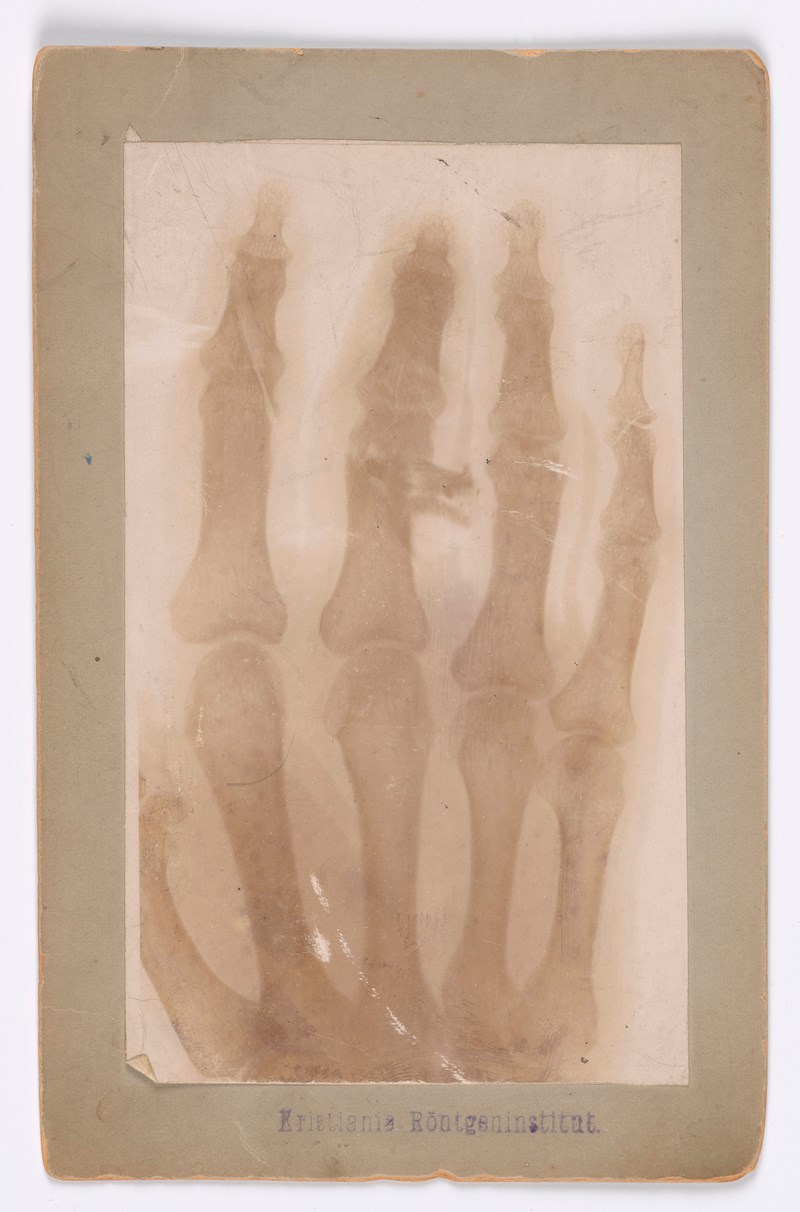 I september 1902 måtte Edvard Munch ta et røntgenbilde av sin venstre hånd etter at han hadde blitt skutt i langefingeren. Bildet viser skjelettet til Munch og skaden som ble påført hans finger.