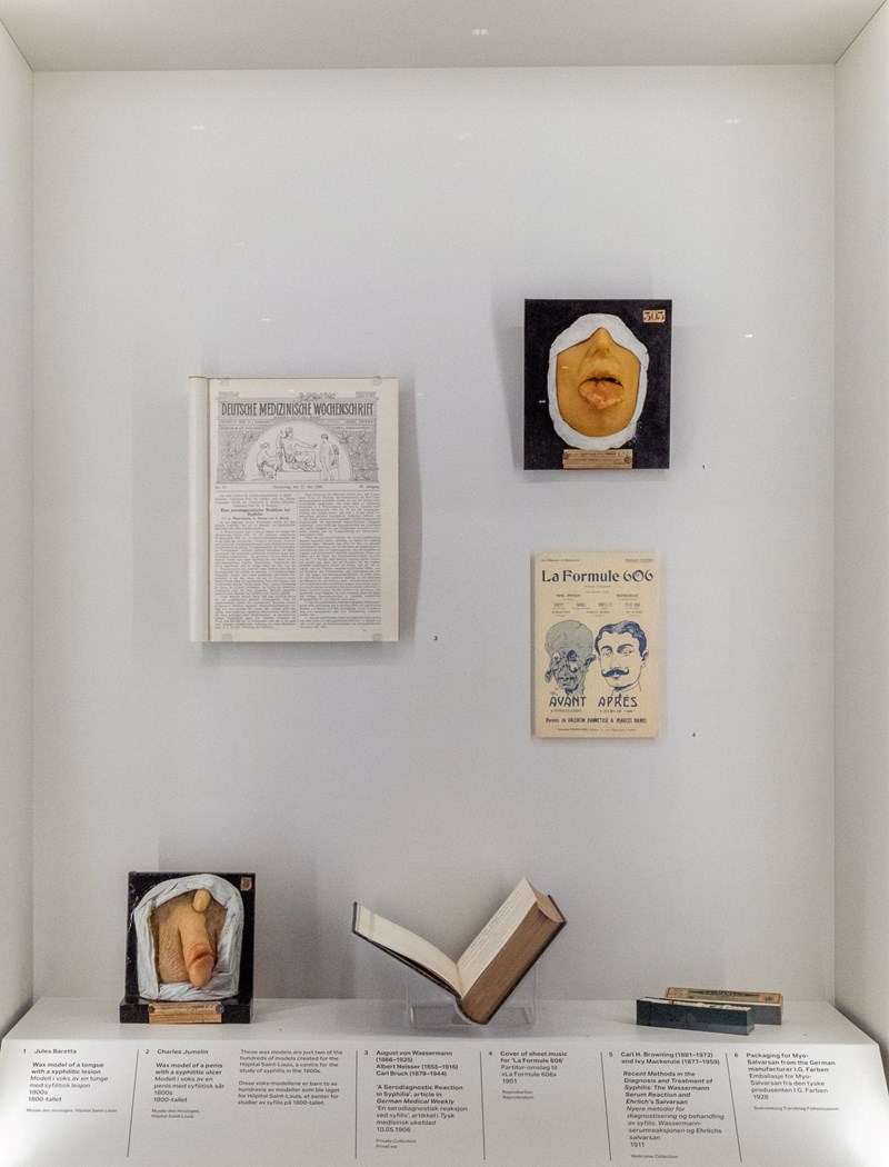 En naturtro anatomisk modell av nedre del av et ansikt. Tungen stikker ut av munnen. På tungen kan man se sår som er symptomer på syfilis.